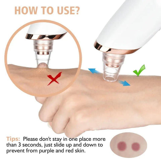 Blackhead Remover for Acne Prone Skin