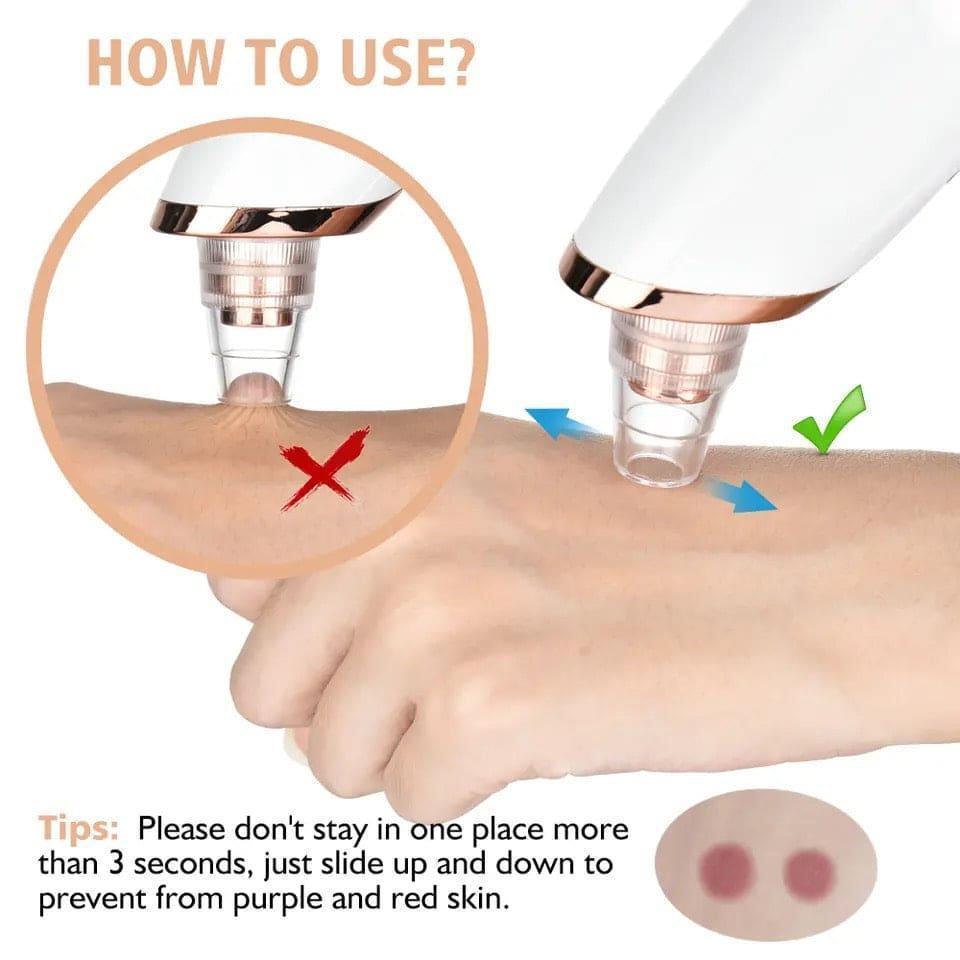 Blackhead Remover for Acne Prone Skin